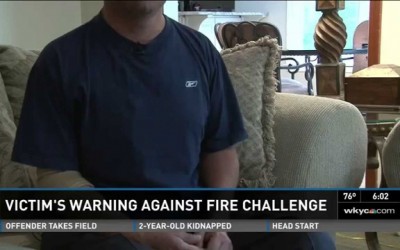 Burn victim has message for ‘Fire Challenge’ takers